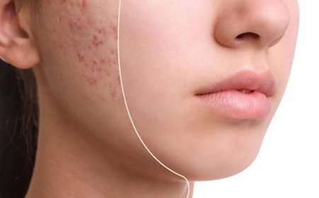 Güzelliğin Düşmanı Sivilceler